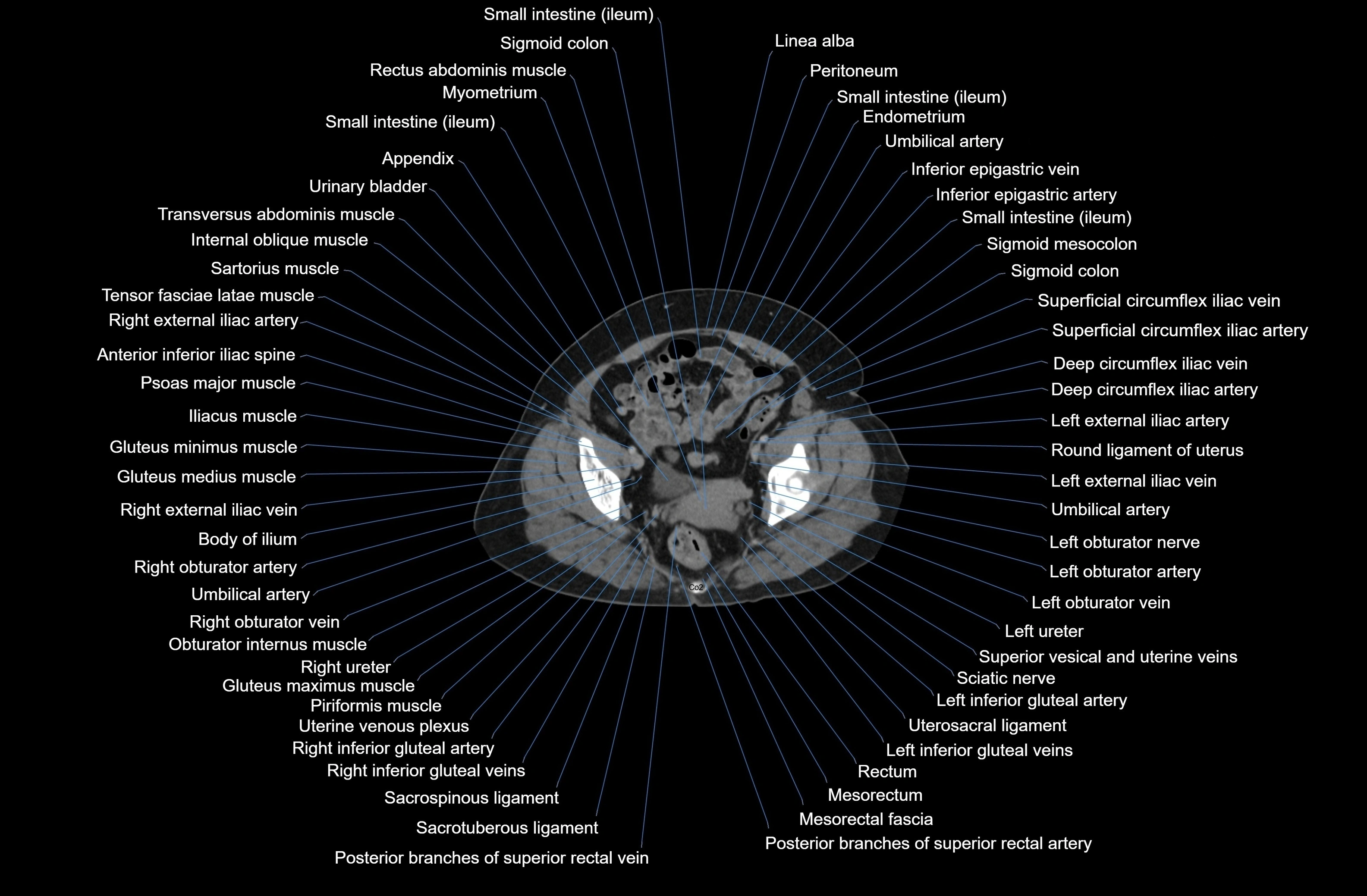 CT Abdomen axial cross sectional anatomy labelled radiology image-00085.webp